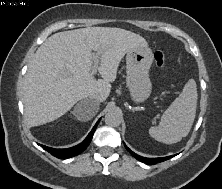 Right Adrenal Adenoma - CTisus CT Scan